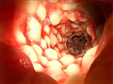 Irritable Bowel Syndrome at Rocky Mountain Gastroenterology
