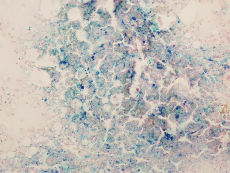 Microscopic view of hemochromatosis inside a patient's body seeking treatment in Denver, CO