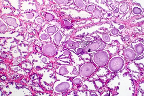 The Pneumatic Dilation PD Bactria