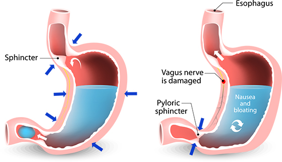 Gastroparesis procedure happening in body RMG,CO