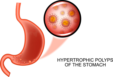 Hypertrophic polyps of the stomach,CO