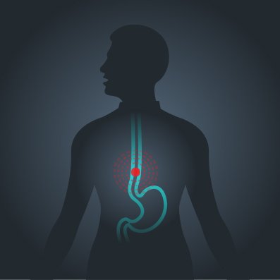 Esophageal disorders affect your esophagus