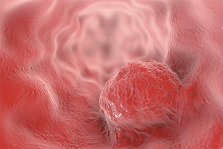 The animation of Eosinophilic Esophagitis.