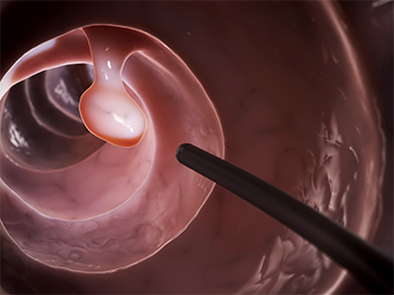 Complex Colon Polyps reference image by RMG,CO