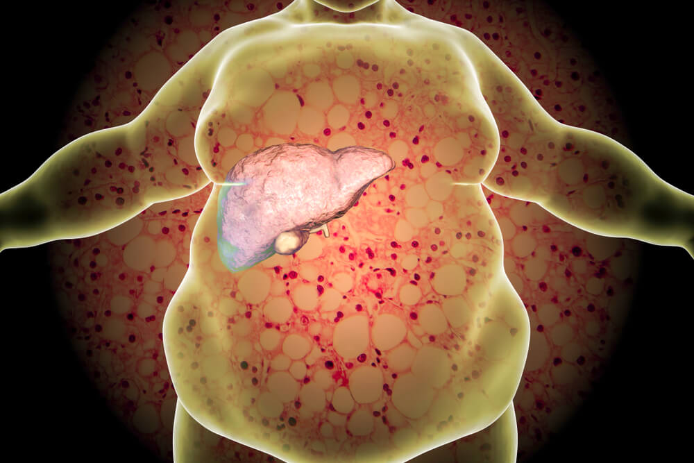 Fatty Liver Disease