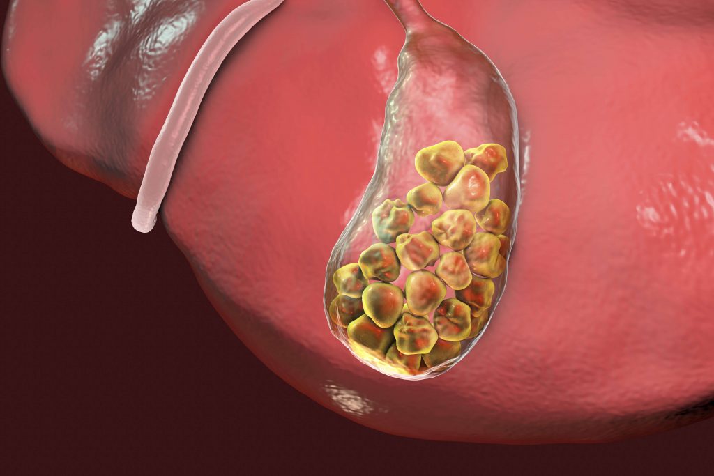The Gallstones Treatments in stomach