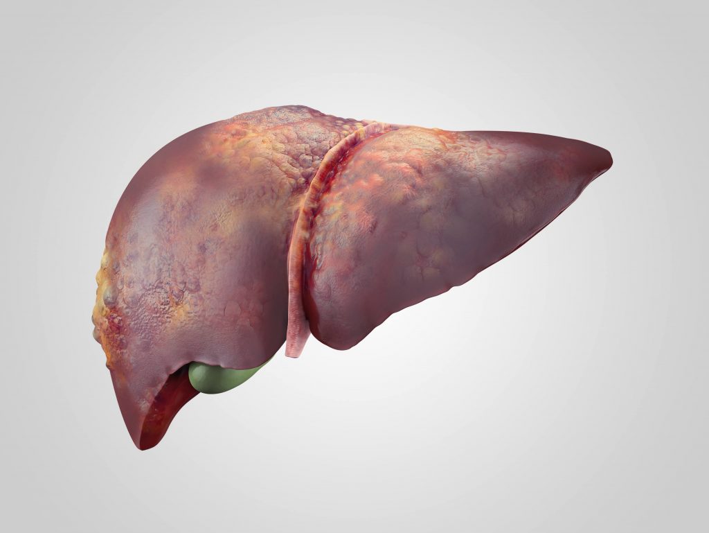 The animation of Cancerous liver