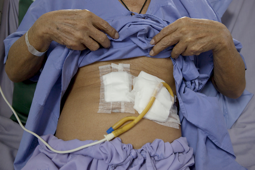 Percutaneous Endoscopic Gastrostomy Procedure